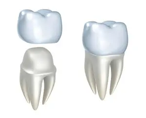 Dental Crowns process