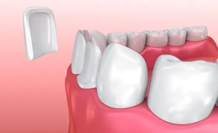 How do porcelain veneers work?