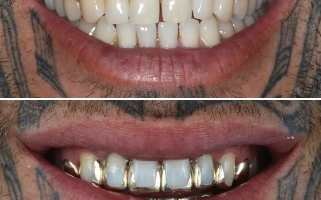 Smile Makeover 12