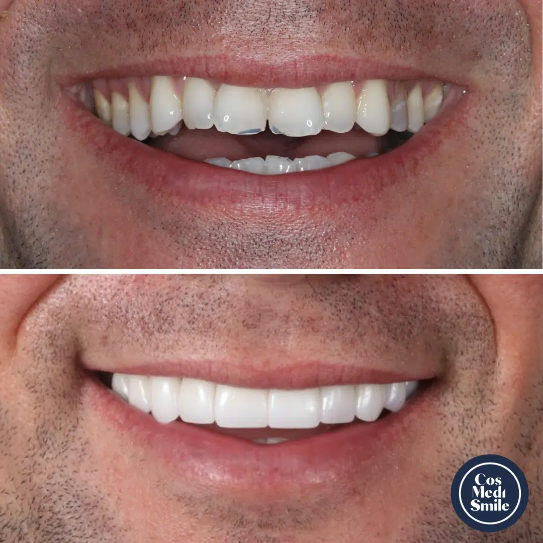 Smile Makeover 14, Dental Crowns