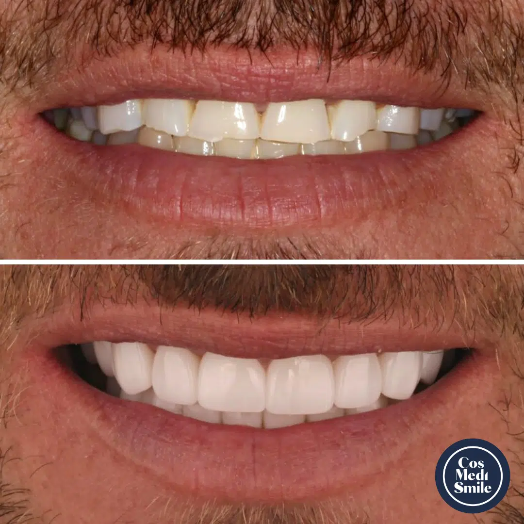 Smile Makeover 15, Dental Crowns