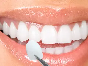 Veneers dental consult