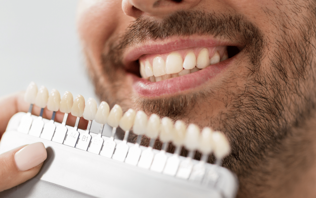 5 Tips on How to Select the Best Shade of Veneers