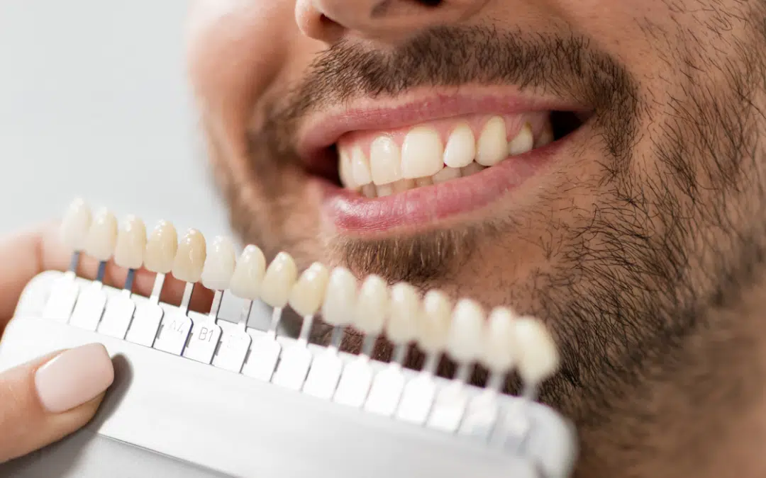 5 Best Porcelain Veneers Shade Selection Tips