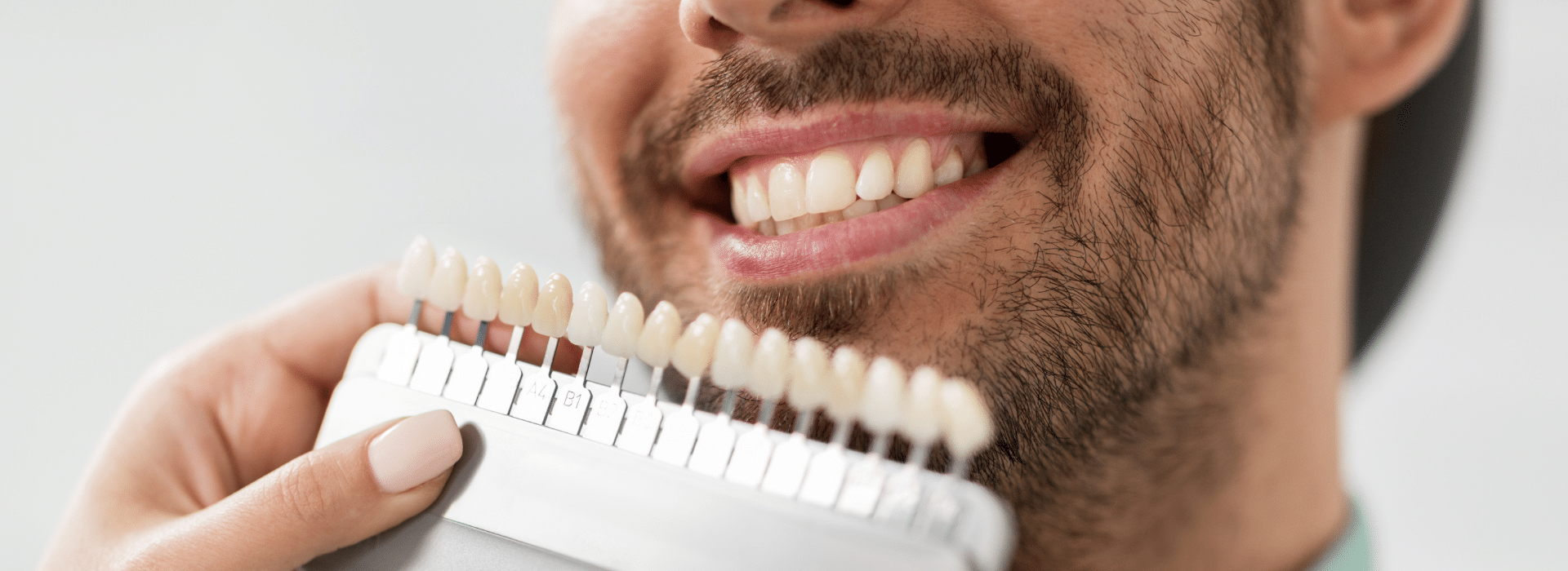 5 Best Veneers Shade Selection Tips