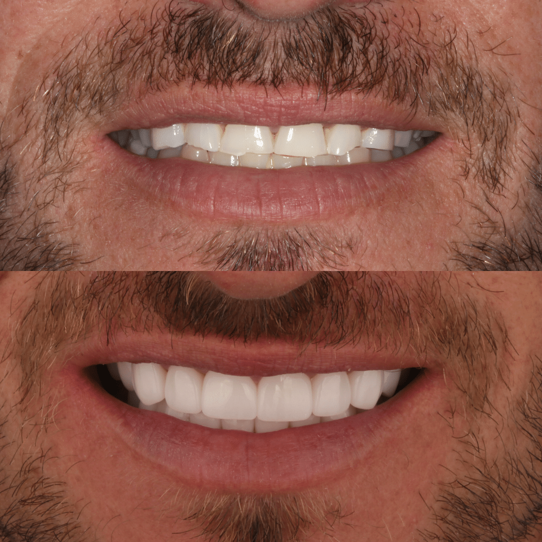 Smile-B&A-31 veneers gold coast
