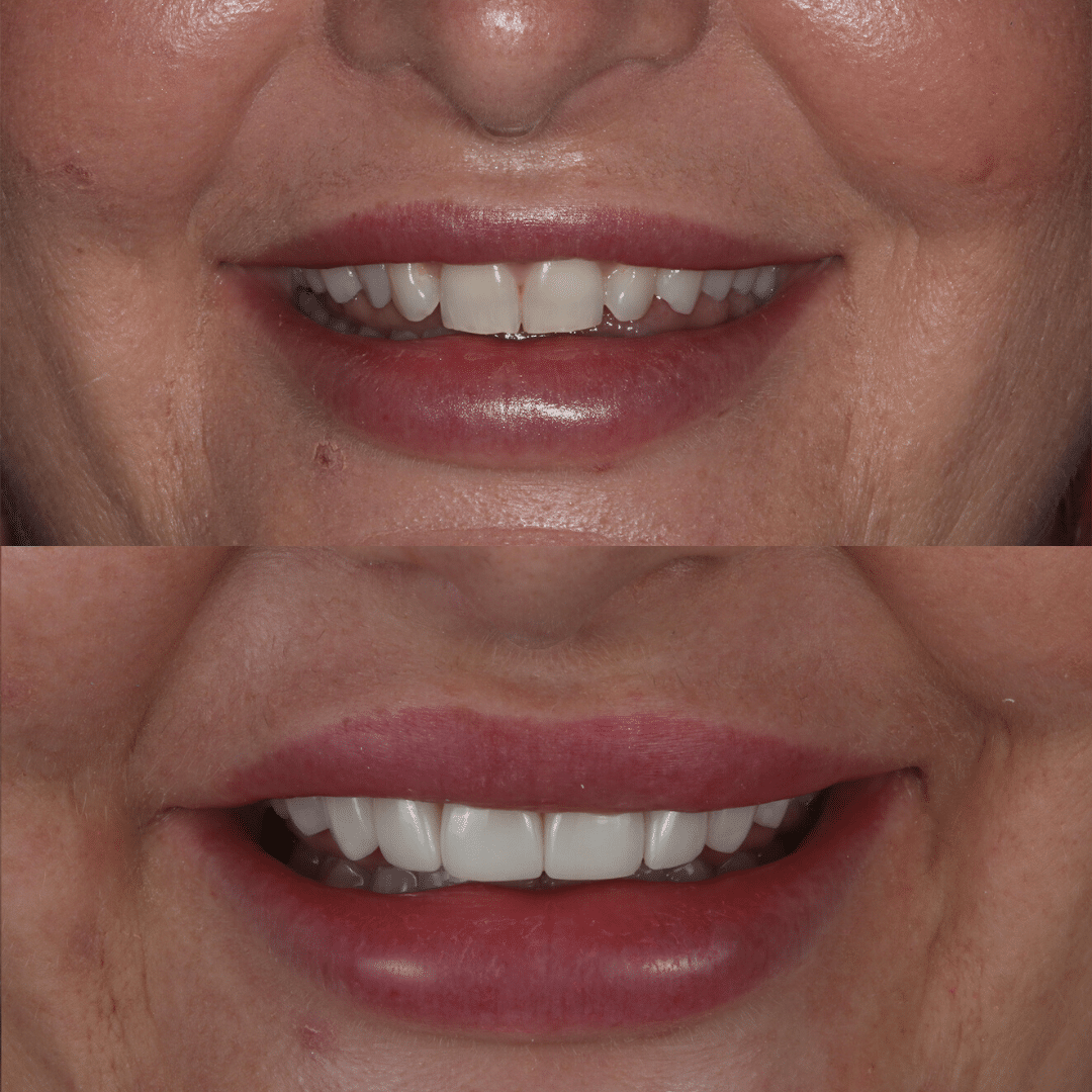 Smile Makeover 32 veneers gold coast