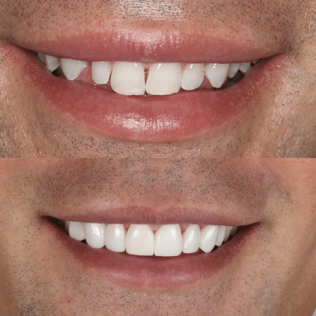 Smile Makeover 34 veneers gold coast