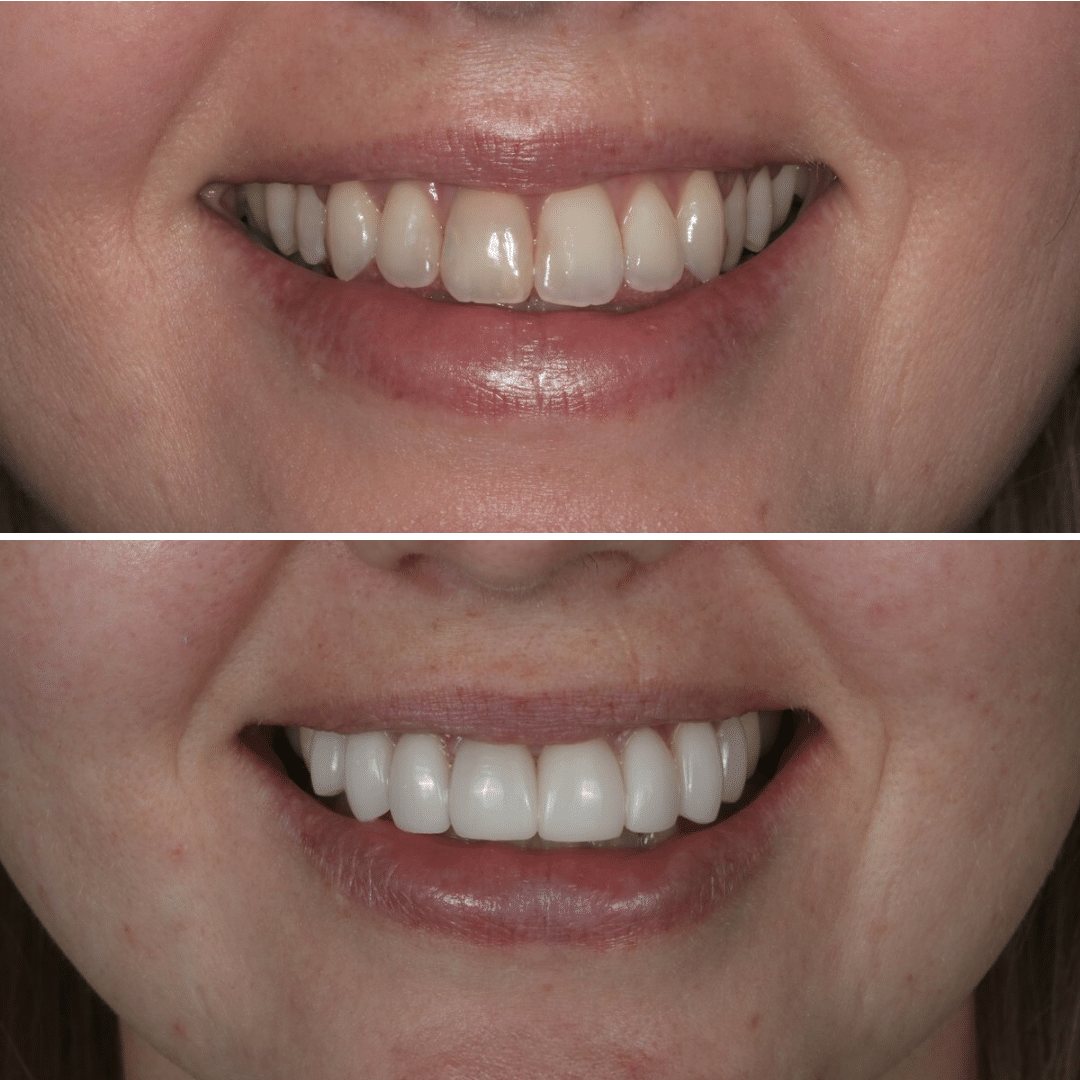 Smile Makeover 39 veneers gold coast