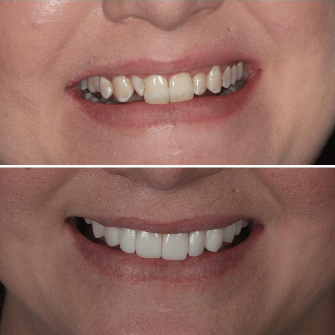 Smile Makeover 43 Smile Makeover 43