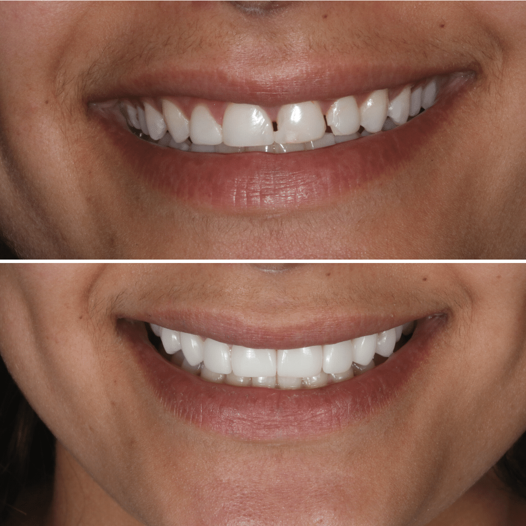 Smile Makeover 44 Smile Makeover 44