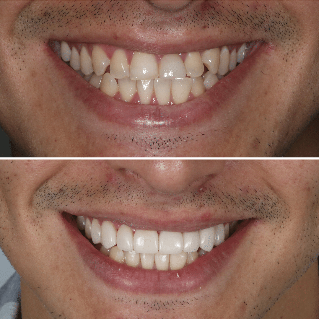 Smile-Makeover-45 Smile Makeover 44