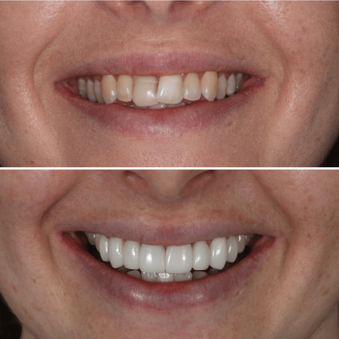 Smile-Makeover-46 Smile Makeover 44