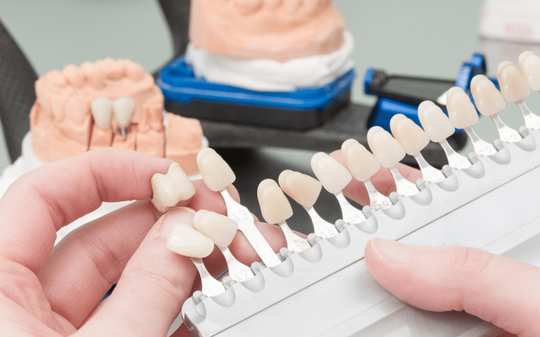 What is the Difference Between Crowns and Veneers?