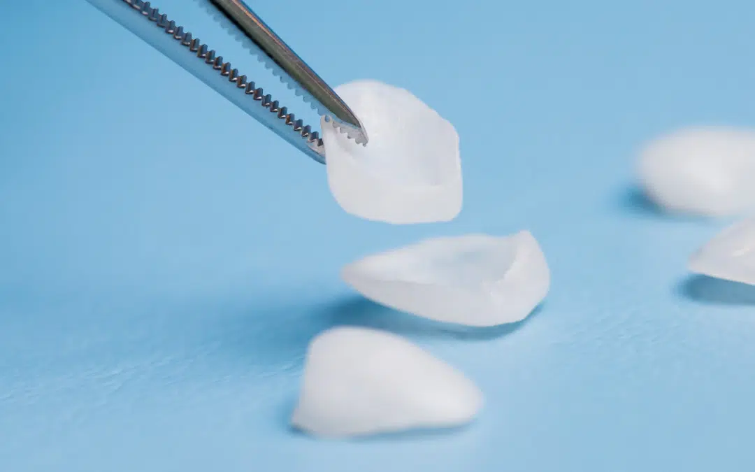 What is the difference between Porcelain Veneers & Composite Veneers?