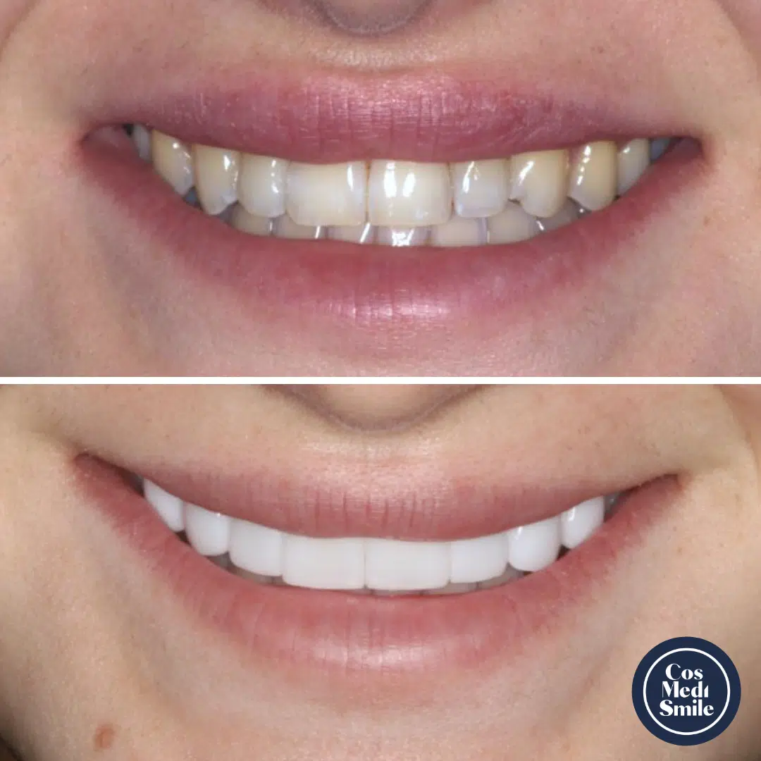 Smile Makeover 1, Porcelain Veneers