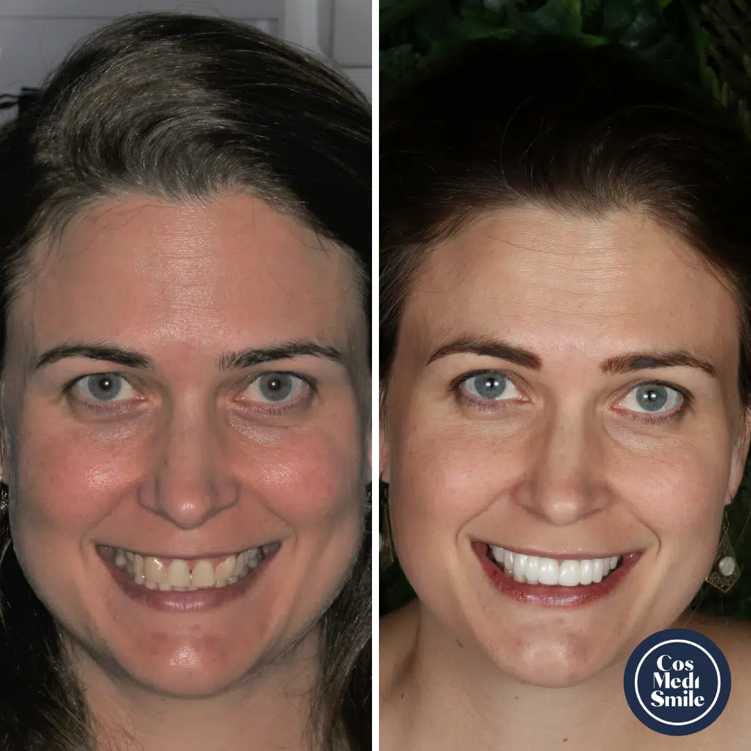 Smile Makeover 17, Dental Crowns face