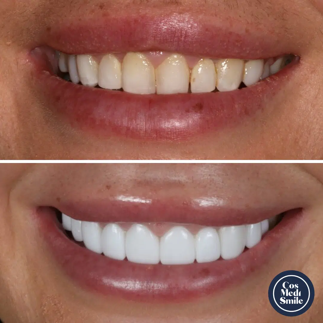 Smile Makeover 20, Porcelain Veneers