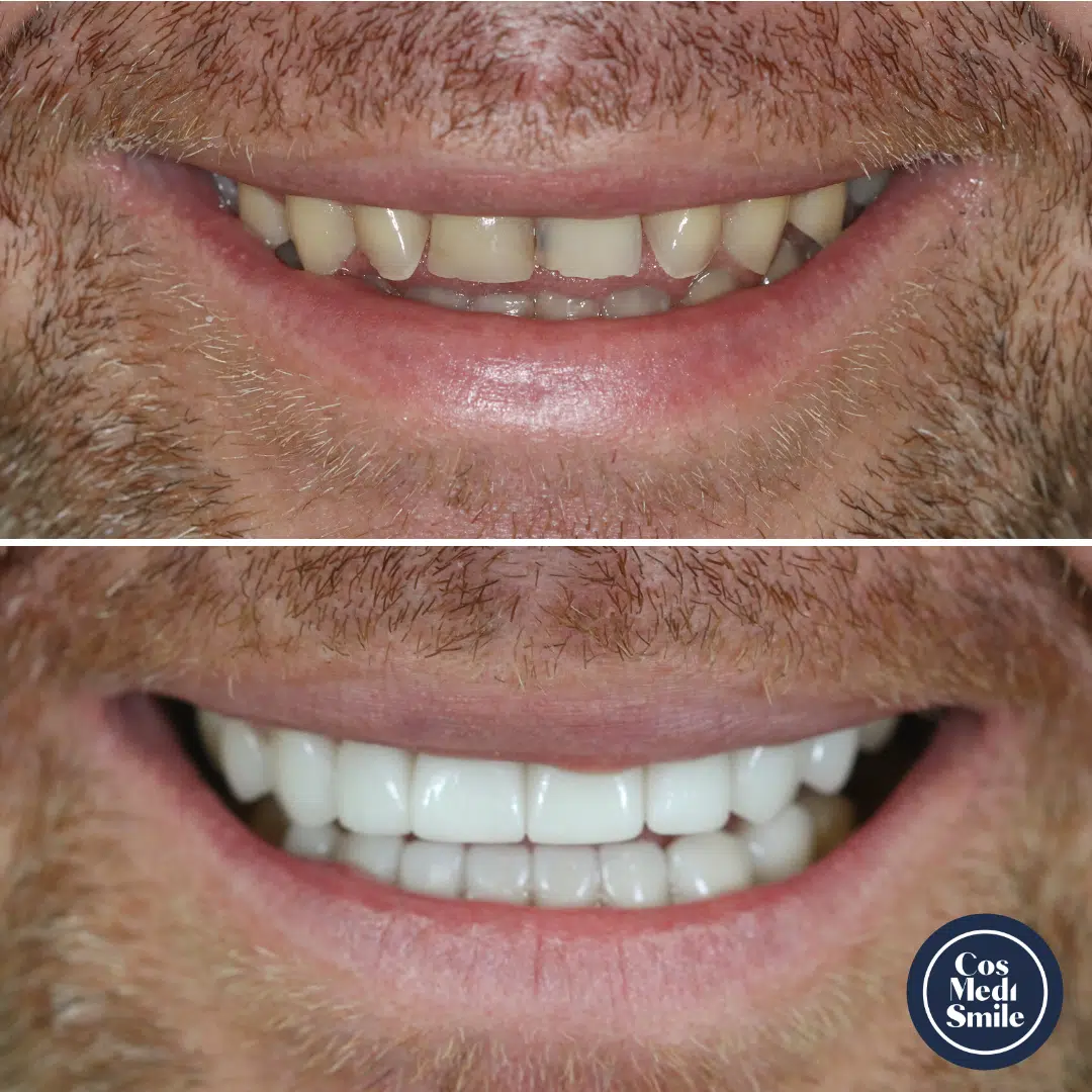 Smile Makeover 21, Porcelain Veneers