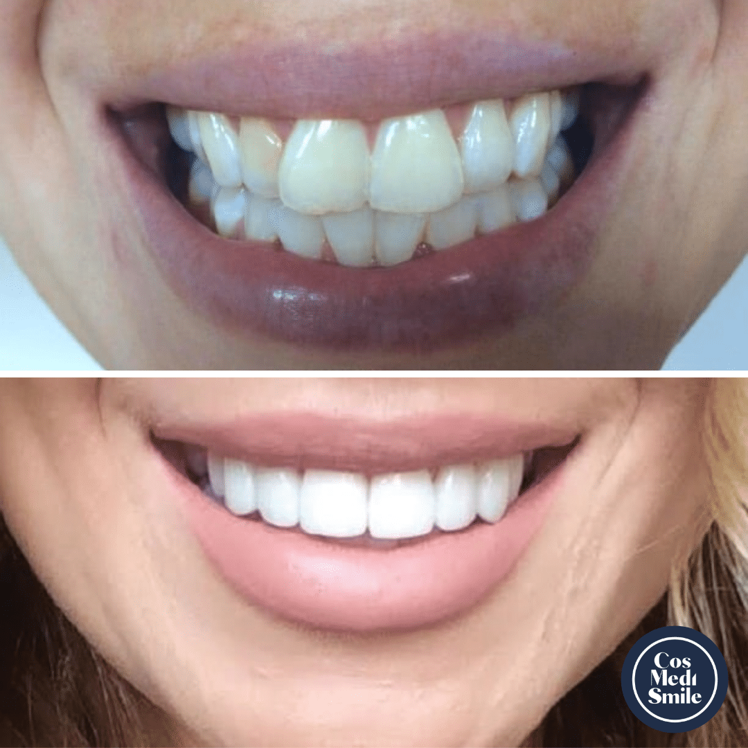 Smile Makeover 24, Porcelain veneers