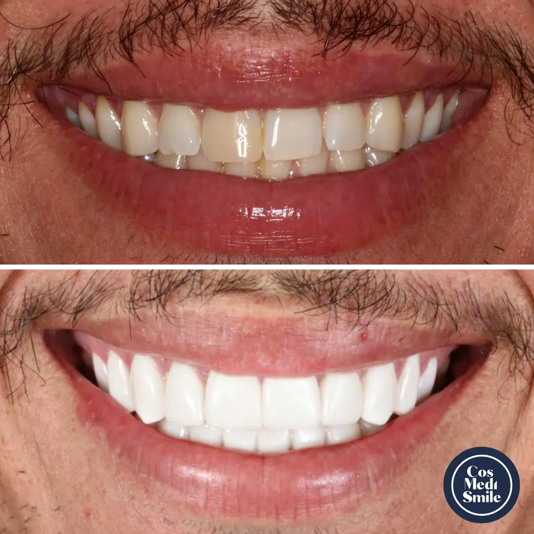 Smile Makeover 26, Porcelain Veneers