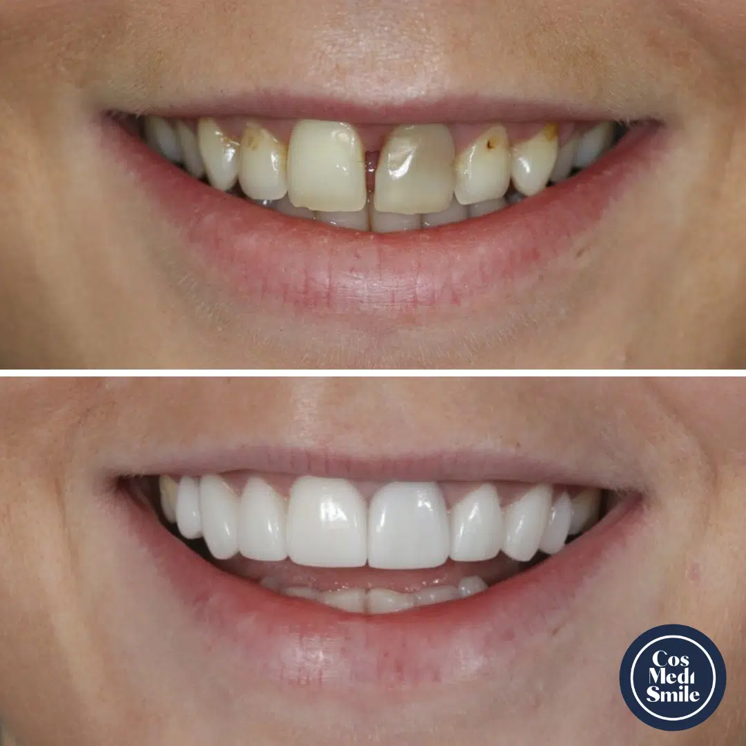 Smile Makeover 26, Veneers