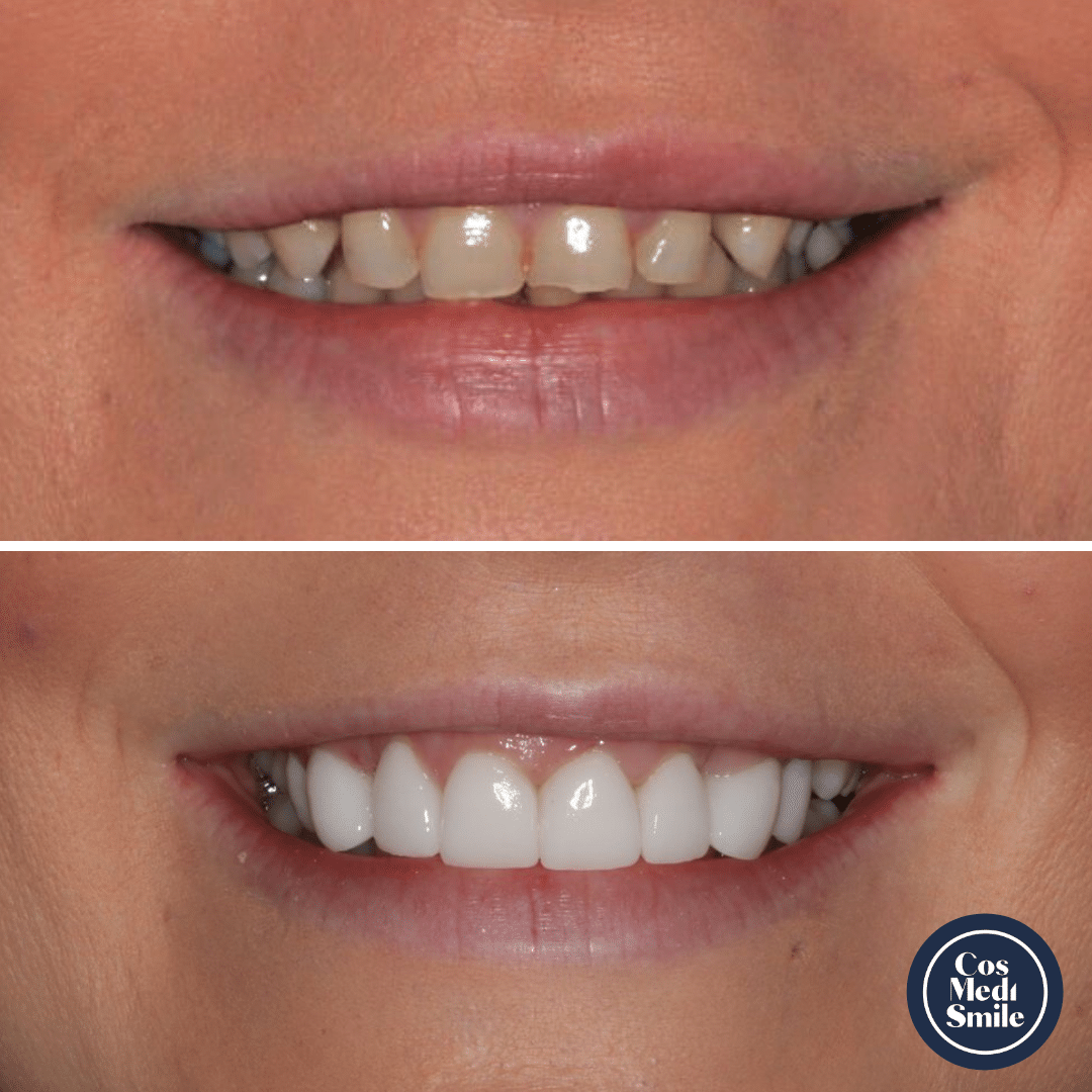 Smile Makeover 29, Dental Crowns