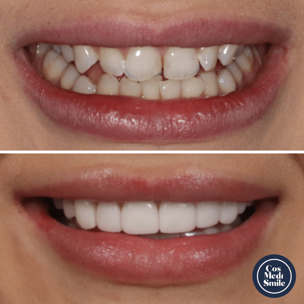 Smile Makeover 31, Porcelain Veneers