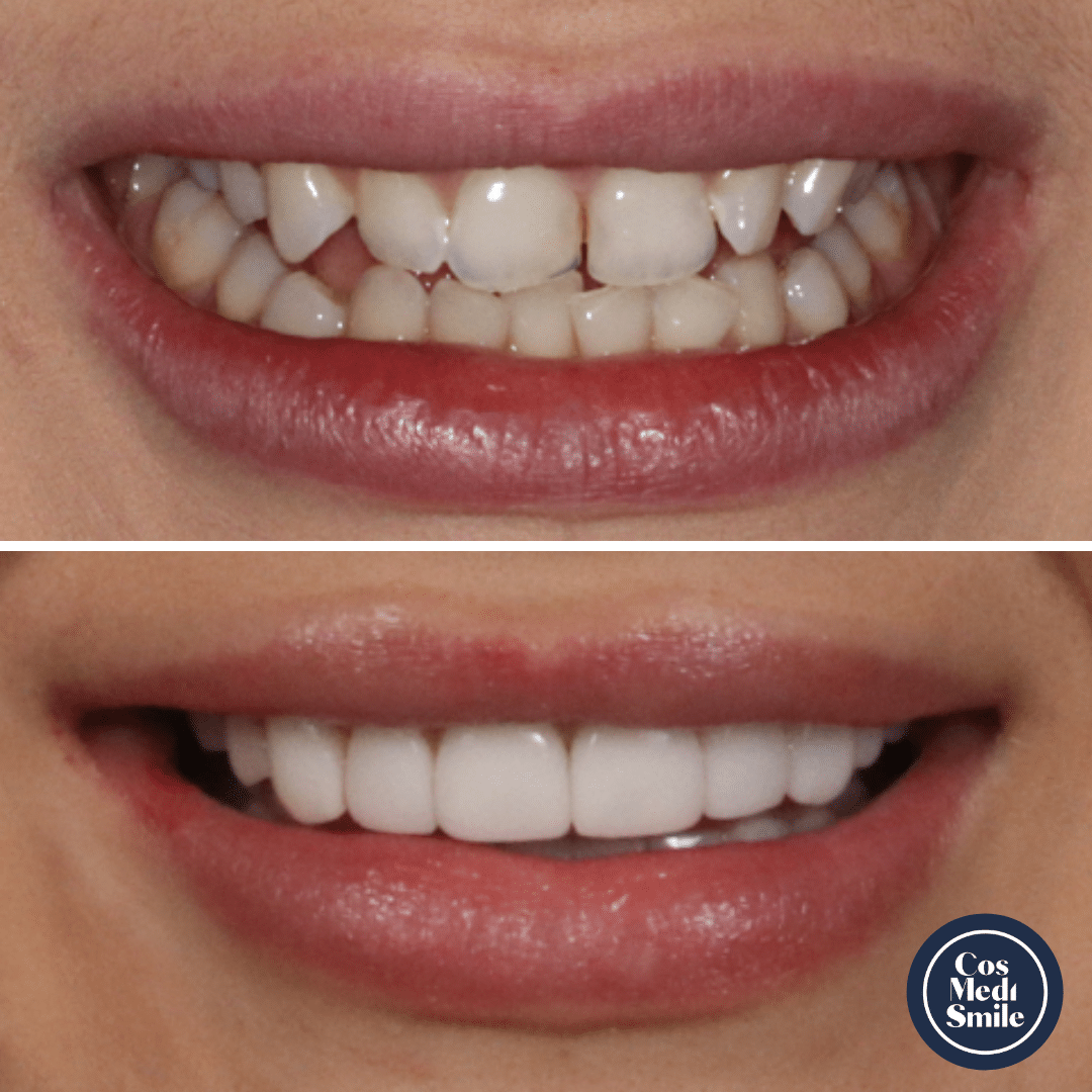Smile Makeover 31, Porcelain Veneers