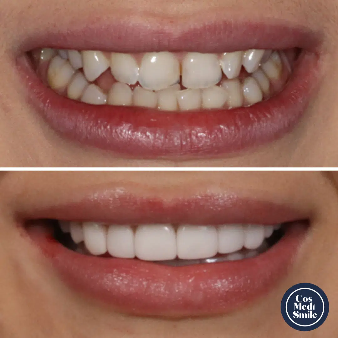 Smile Makeover 31, Porcelain Veneers