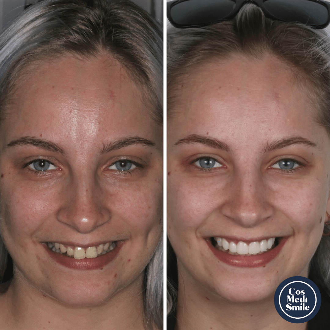 Smile Makeover 32, Pocelain Veneers Face