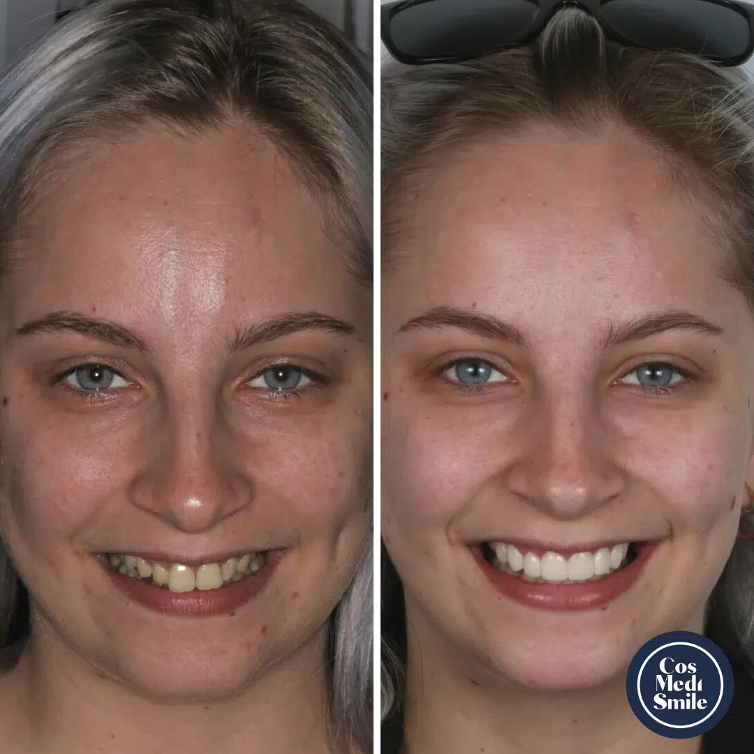 Smile Makeover 32, Pocelain Veneers Face