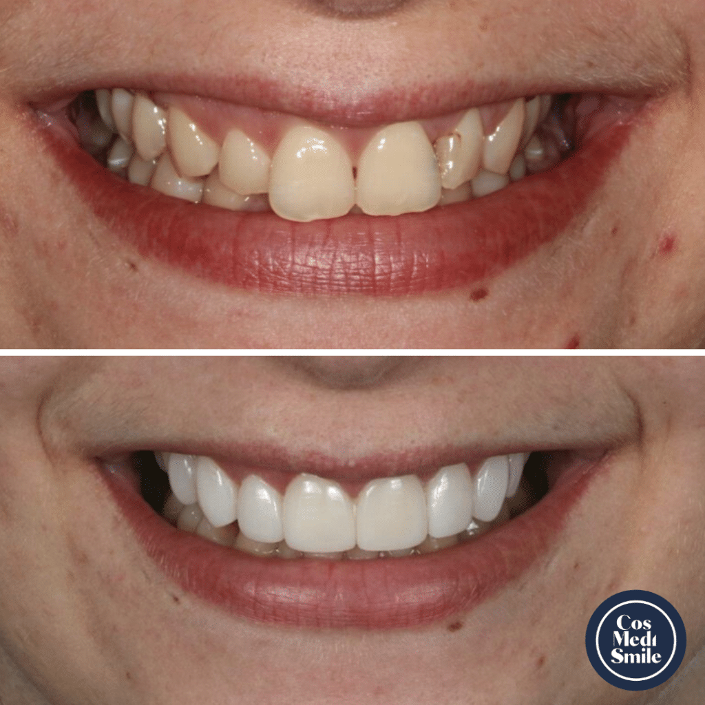 Smile Makeover 32, Porcelain Veneers