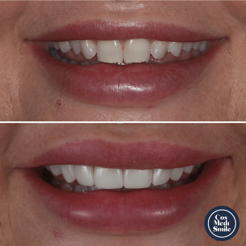 Smile Makeover 34, Porcelain Veneers