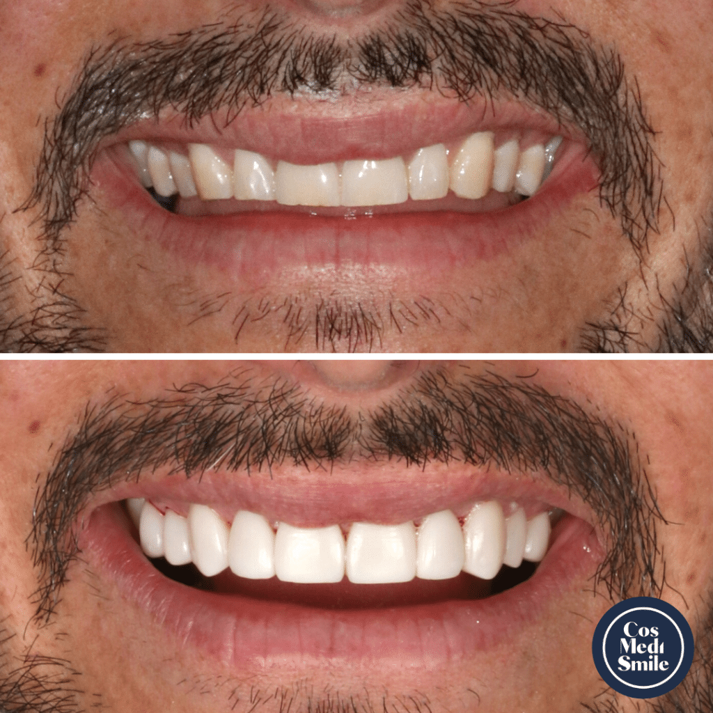 Smile Makeover 35, Porcelain Veneers