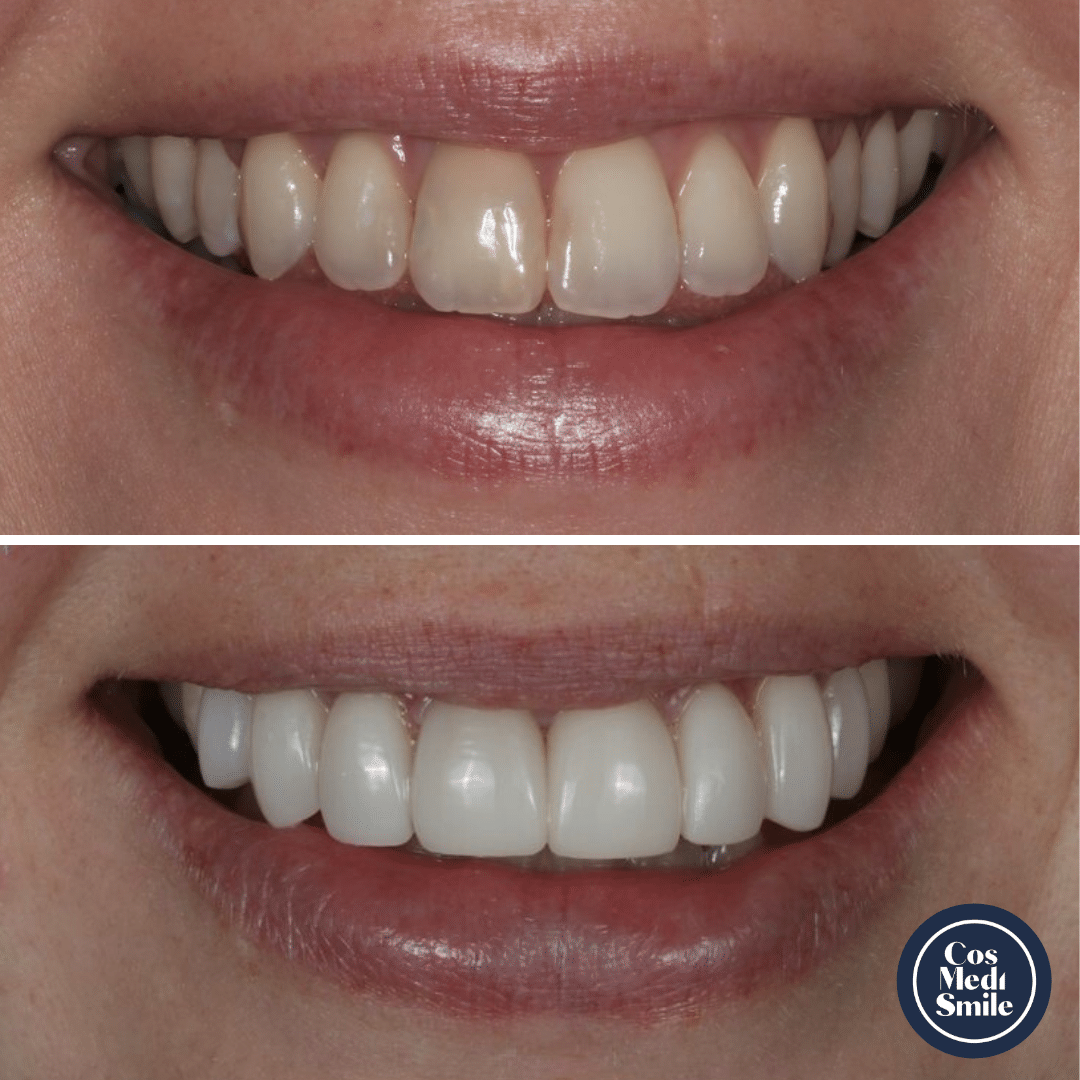 Smile Makeover 40, Porcelain Veneers Smile Makeover 40, Porcelain Veneers