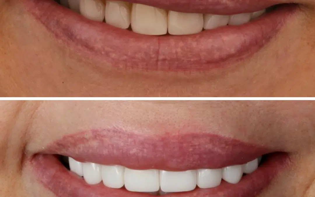 Smile Makeover 41