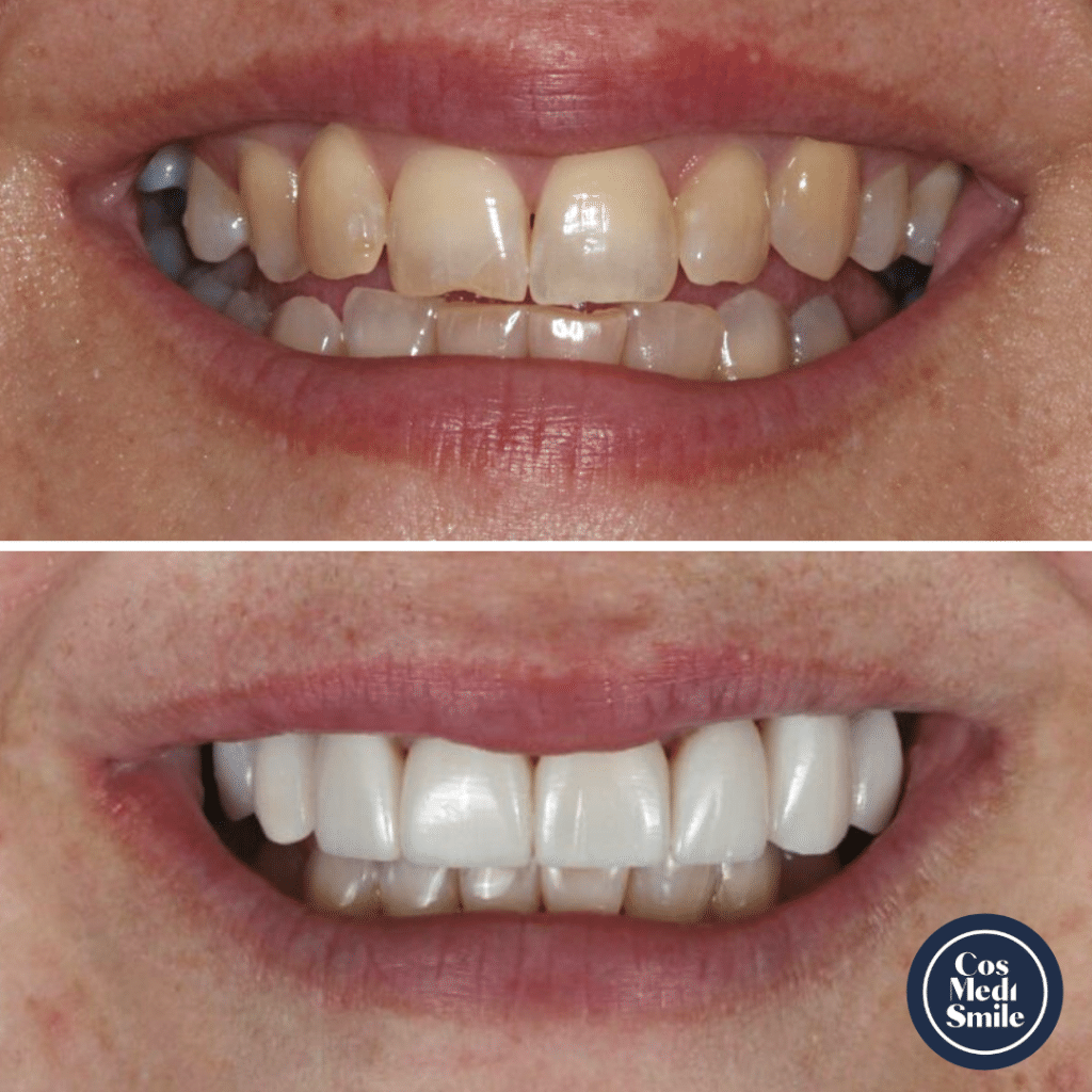 Smile Makeover 42, Porcelain Veneers