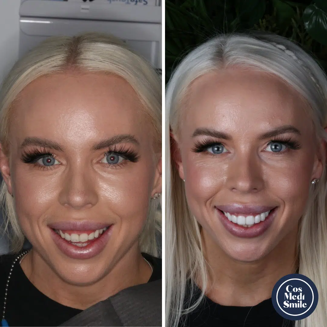 Smile Makeover 43, Porcelain Veneers Face