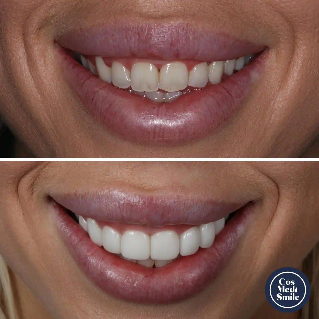 Smile Makeover 43, Porcelain Veneers