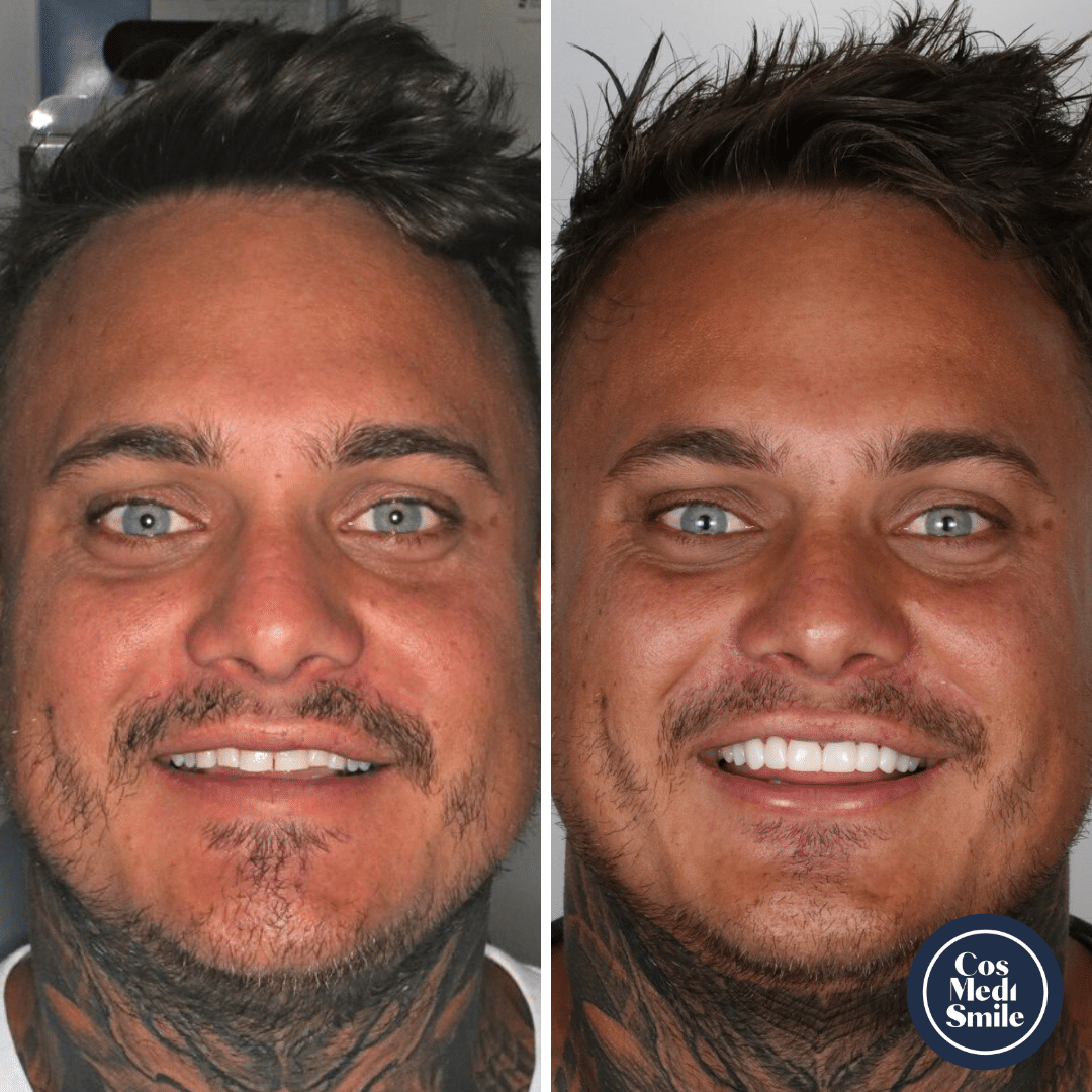 Smile Makeover 48, Porcelain veneers Face Smile Makeover 48, Porcelain veneers Face