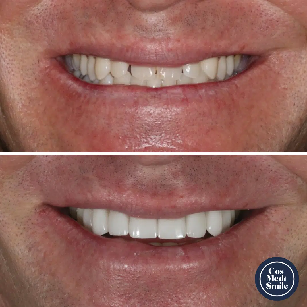 Smile Makeover 49, Porcelain Veneers