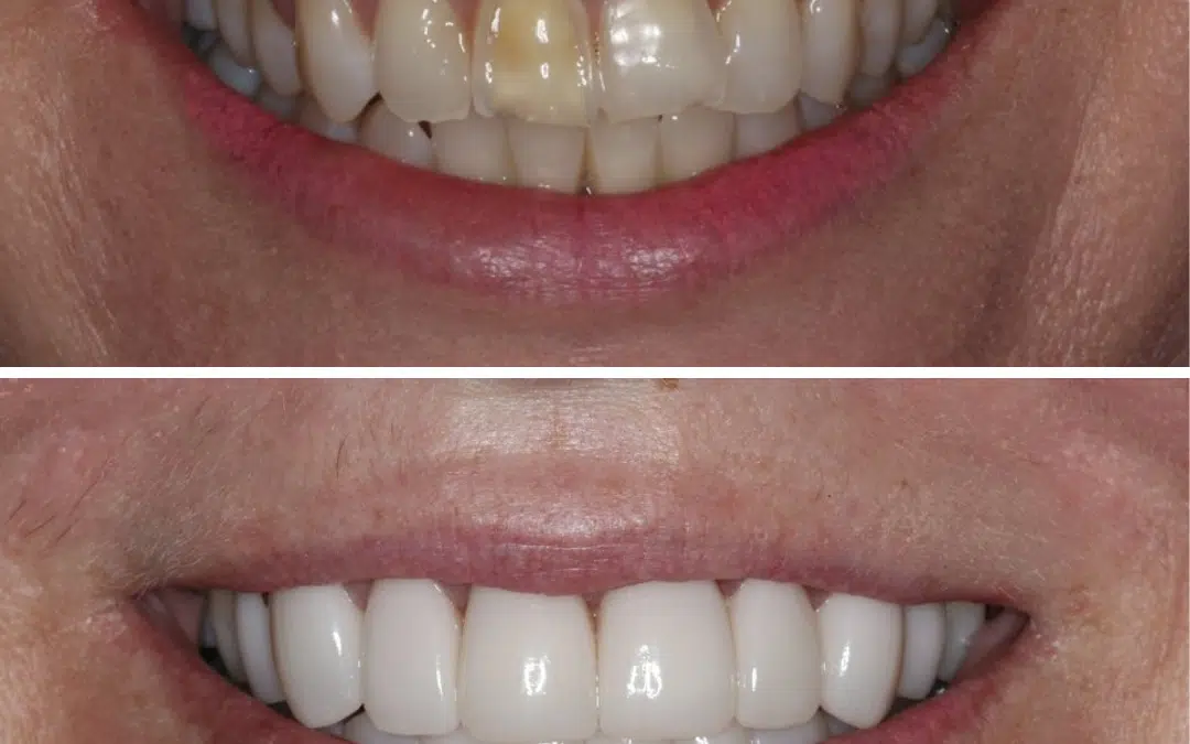 Smile Makeover 50