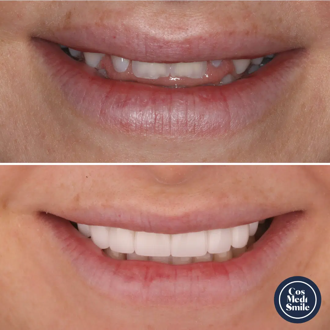 Smile Makeover 51, Dental Crowns