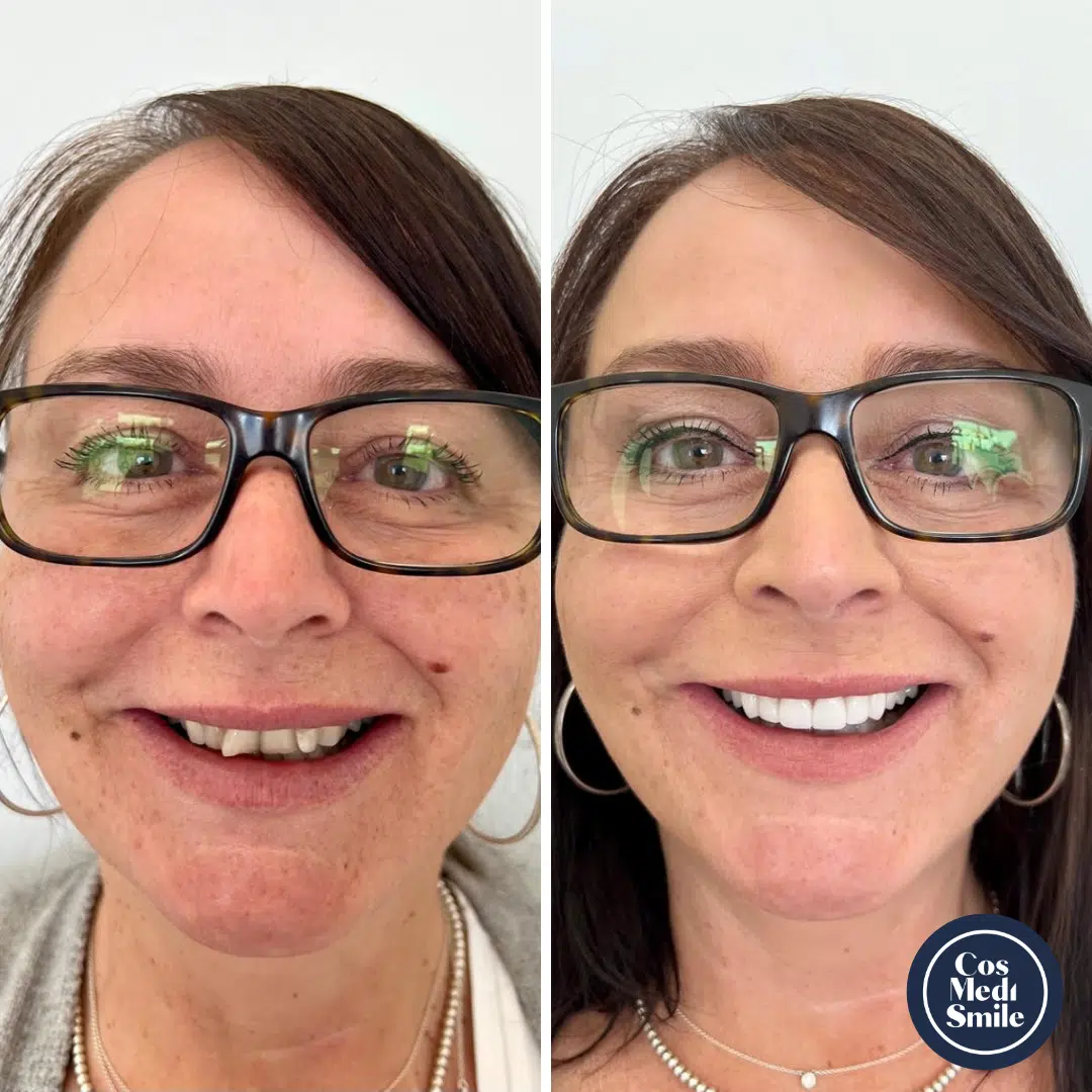 Smile Makeover 53, Dental Crowns Face