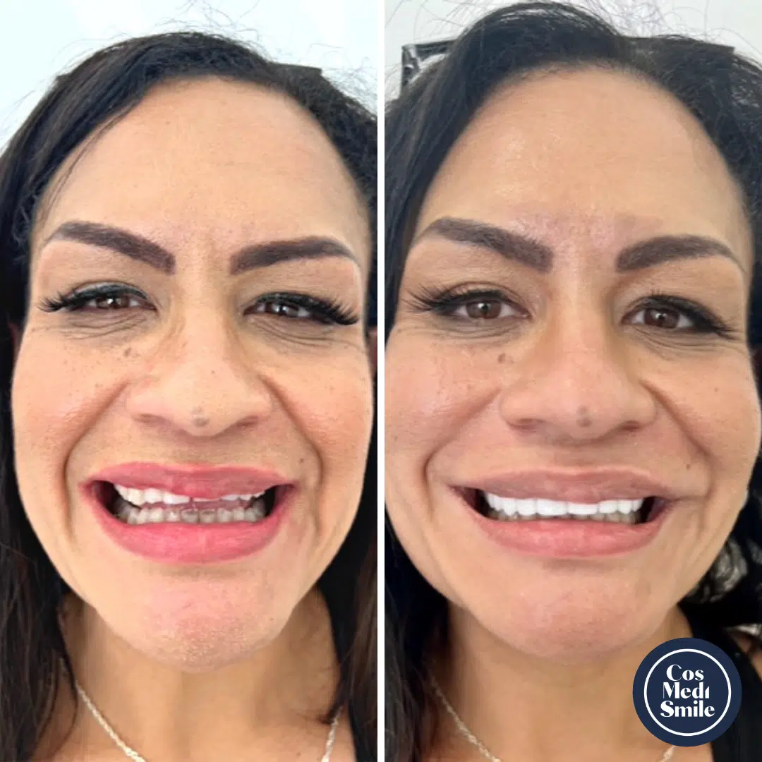 Smile Makeover 54, Porcelain Veneers and Dental Crowns Face