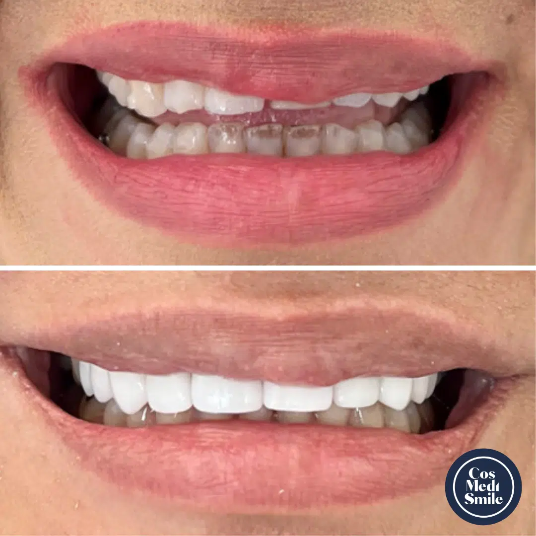 Smile Makeover 54, Porcelain Veneers and Dental Crowns