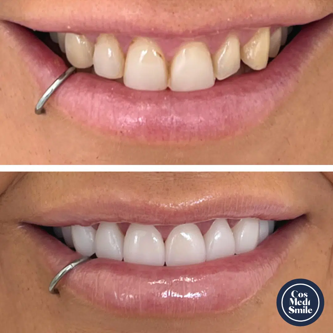 Smile Makeover 57, Porcelain Veneers