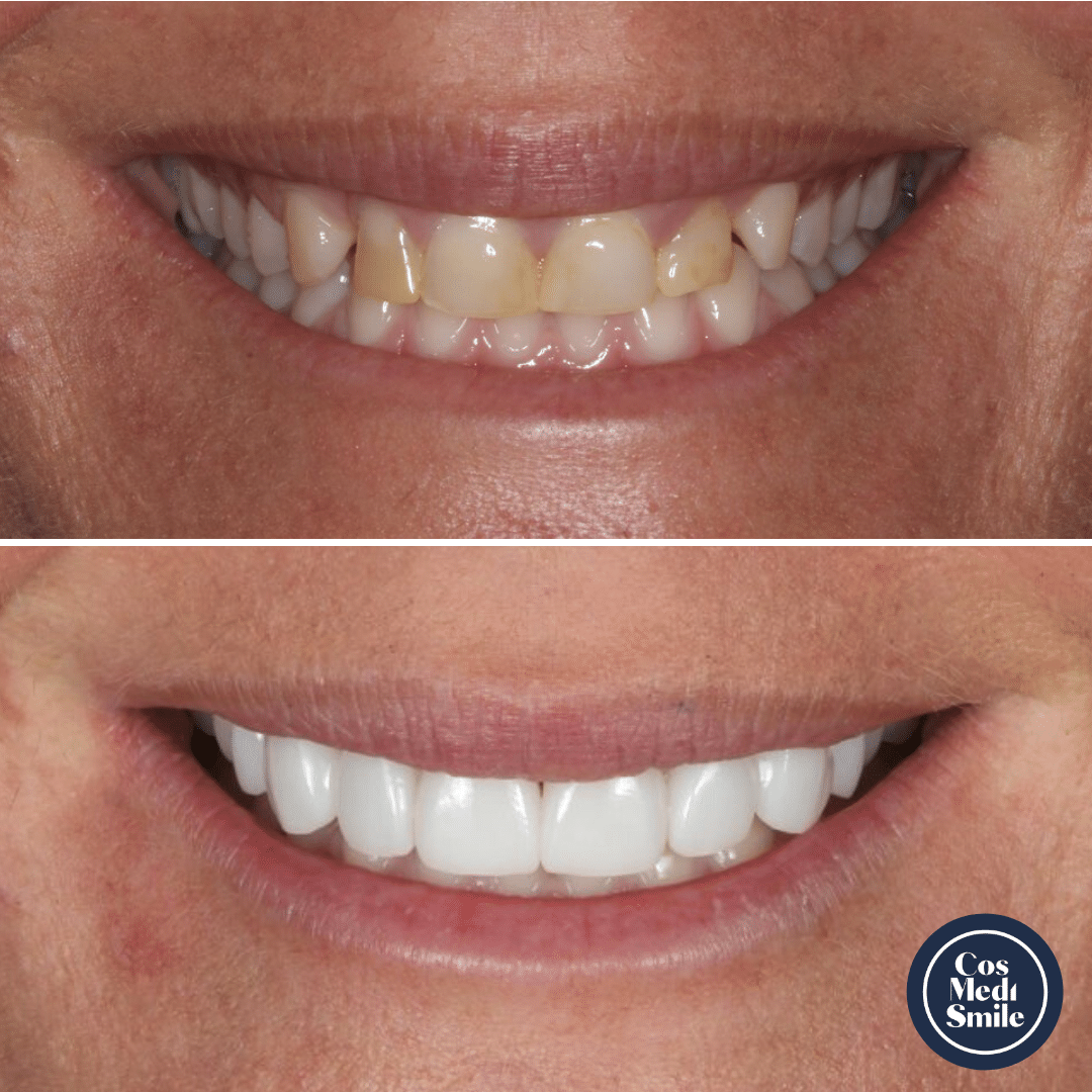 Smile Makeover 58, Dental Crowns
