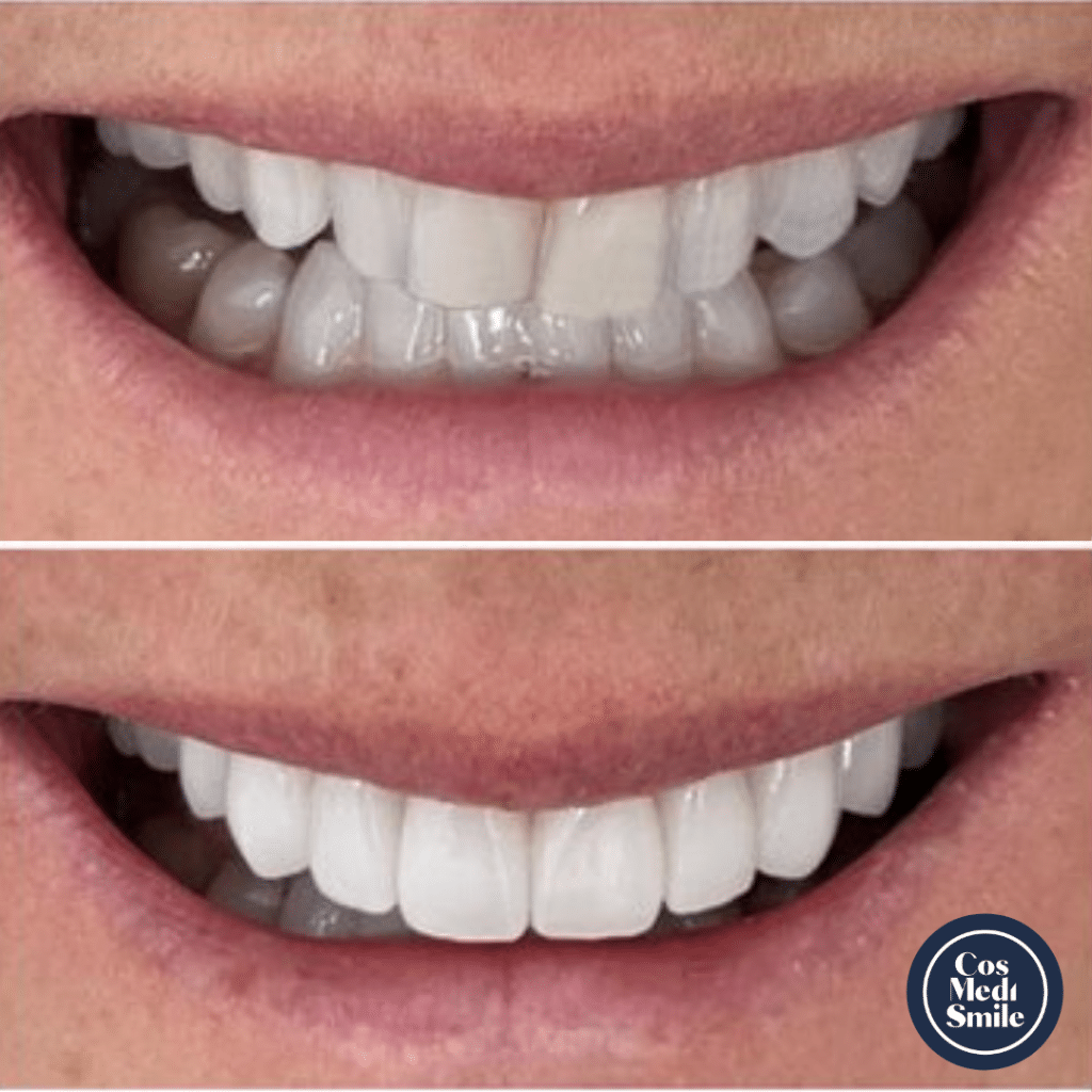 Smile Makeover 60, Dental Crowns